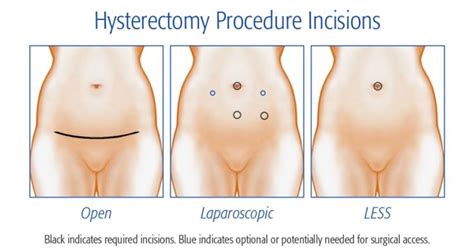 pin on hysterectomy oopherectomy