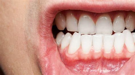 gum disease everyday health