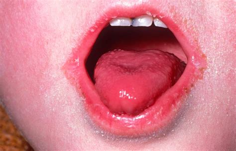 cases of scarlet fever are soaring here are the symptoms