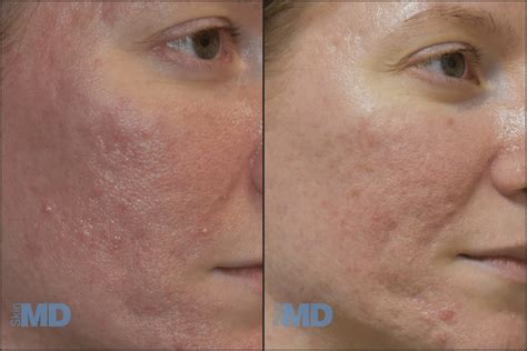fractional resurfacing skin md laser cosmetic group