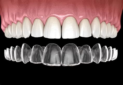 orthodontics warsaw  invisalign clear braces cosmetic dentist