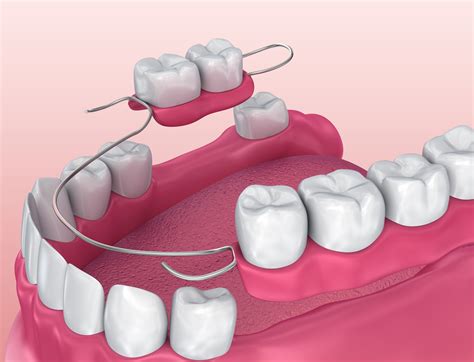 partial dentures philadelphia pa dr bruce  wilderman