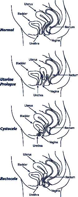 uterine prolapse physiopedia