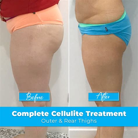 Cellulite Results Before And After Elite Body Contouring