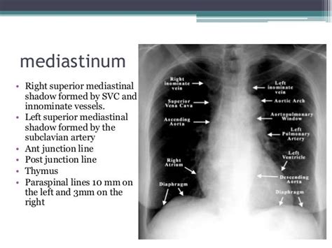 Chest X Ray Positioning