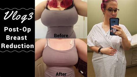 vlog  breast reduction day   youtube