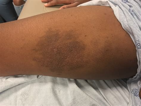 hyperpigmented patch   thigh clinical advisor