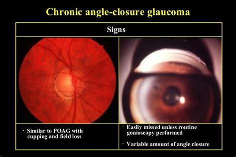 primary angle closure glaucoma