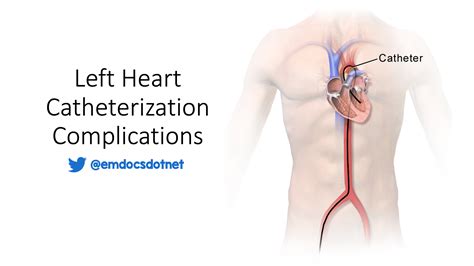 emdocsnet emergency medicine educationleft heart catheterization