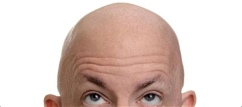 short white men      bald study ary news