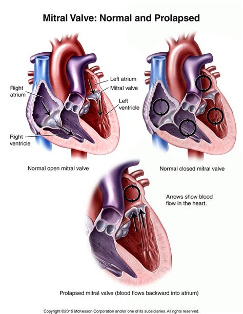 Heart Valve Disorders Discharge Information Tufts Medical Center