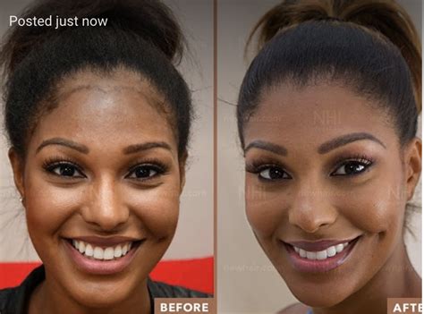 african american female hairline lowering transplant