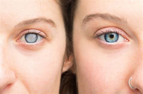 cataract surgery work eye effects calgary