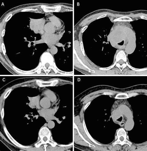 Figure1 A B Chest Ct Revealed A Mass In The Right Middle Lobe Of The