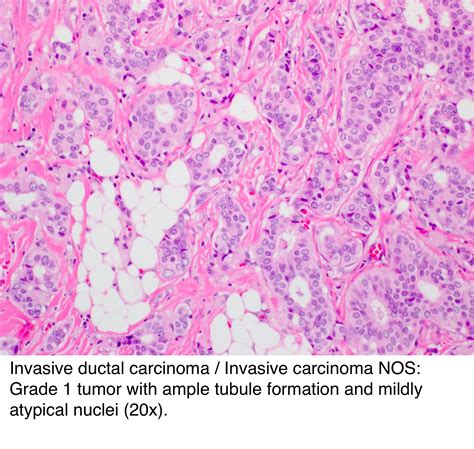 pathology outlines who classification