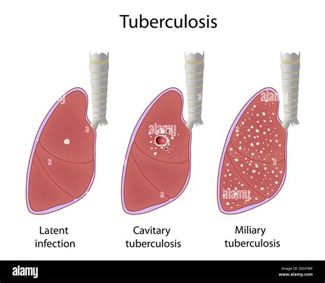 pulmonary tuberculosis latent infection cavitary and miliary tb stock