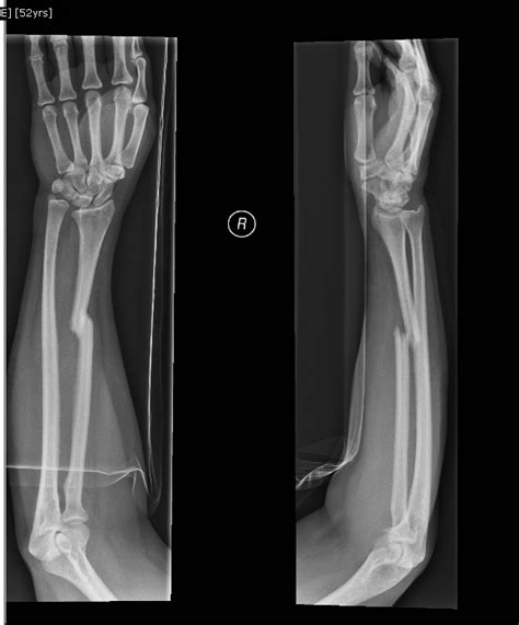 forearm single bone fracture  orthopedics malaysia blog