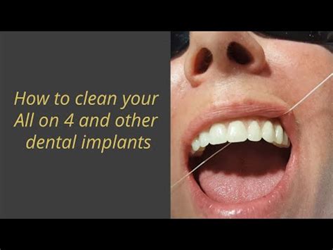 clean       dental implants youtube