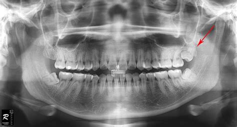 wisdom teeth surgery cases      clinic prestige dental carecommy