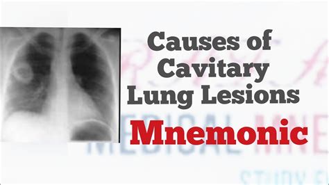cavitary lung lesions mnemonic cavitary
