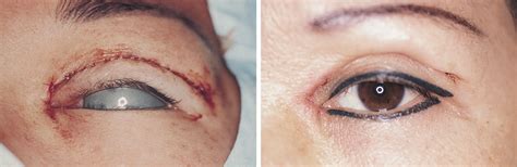 modified z epicanthoplasty in the asian eyelid jama facial plastic