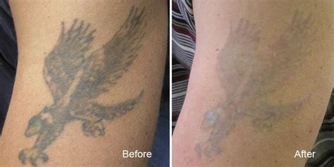 tattoo removal vancouver remove tattoos safely  fast