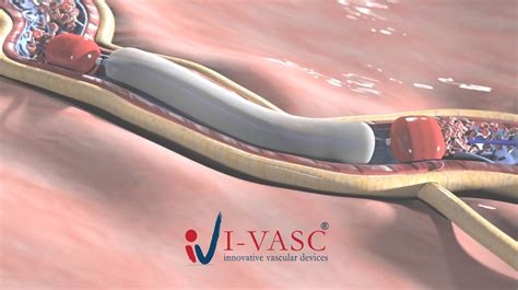 vasc announces   clinical   velex  vasc