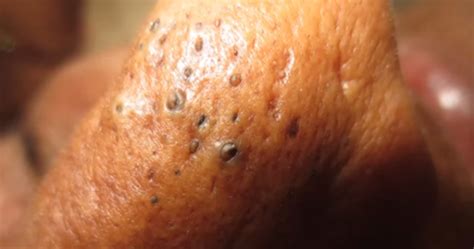 Video This Disgusting Video Of Zit Popping Is So Bad We