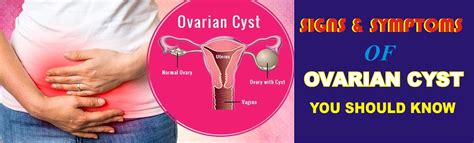 Signs And Symptoms Of Ovarian Cysts