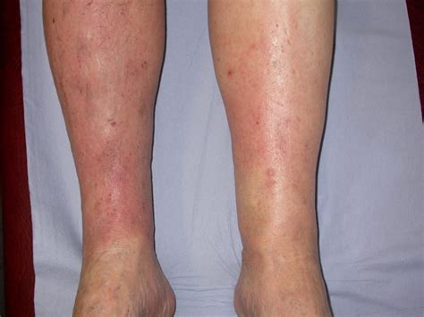 stasis dermatitis  symptoms diagnosis treatment