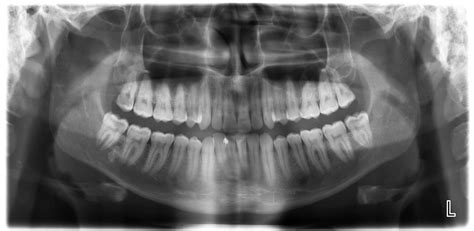 X Rays And Radiographs Oceansight Dental And Implants
