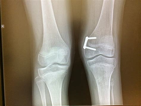 fibular hemimelia leg lengthening  plate   months post surgery
