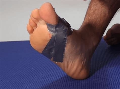 turf toe home rehab sprained big toe treatment