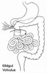 Embryology Volvulus Midgut Intestine sketch template