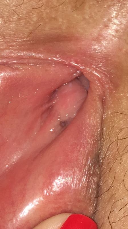 vagina herpes picture excelent porn