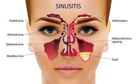sinus problems natural solutions  work sinusitis severe cough
