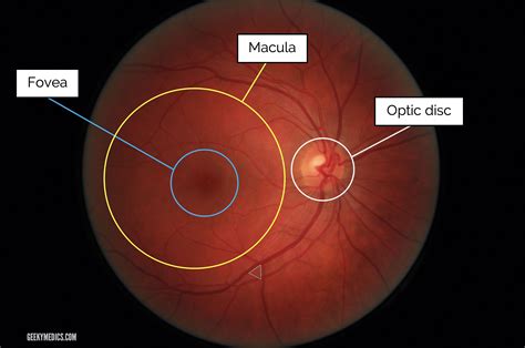 fundoscopic appearances  retinal pathologies geeky medics