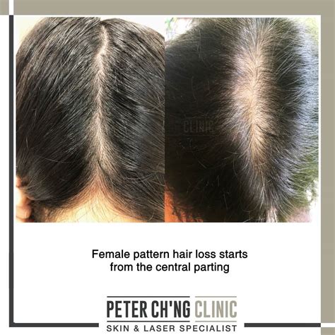 patient mailbox   treat hair loss peter chng skin specialist kl malaysia