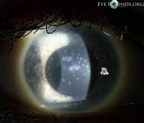 Macular Corneal Dystrophy The University Of Iowa