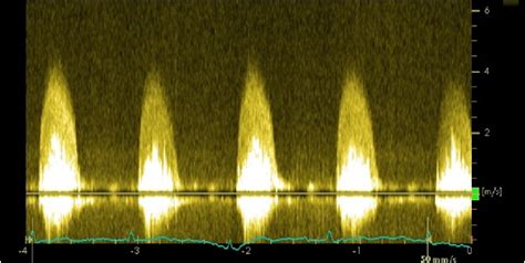 Av Stenosis Low Flow Low Gradient