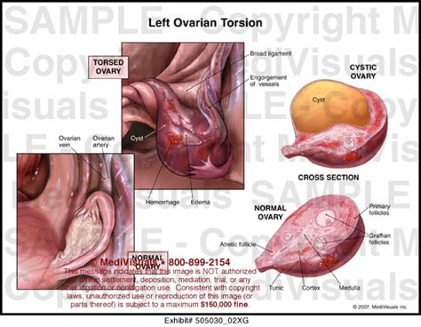 left ovarian torsion medical illustration