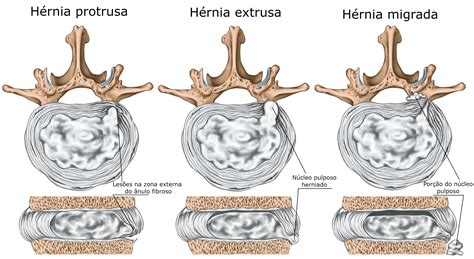 hernia de disco tipos causas sintomas tratamentos ortopedia infoescola