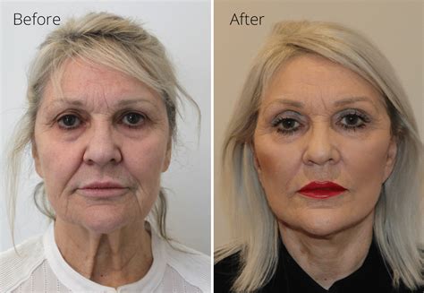 facelift neck lift performed  sedation anaesthesia