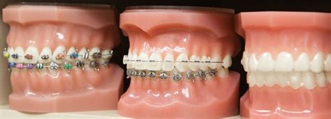 Dental Braces San Antonio Affordable Orthodontics Texas