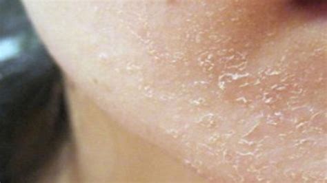 kulit kering  simptom  penyakit  menyerang tubuh kita