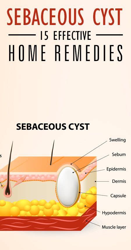 14 home remedies to treat sebaceous cysts health remedies remedies