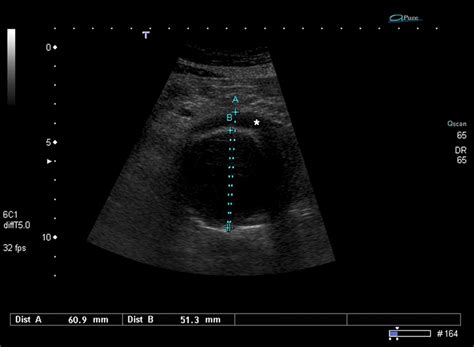 sonographers blog ultrasound screening