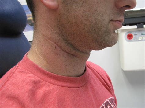 arch branchial cleft cyst case  iowa head  neck protocols