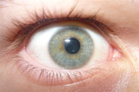 file light blue eye with heterochromia wikimedia commons