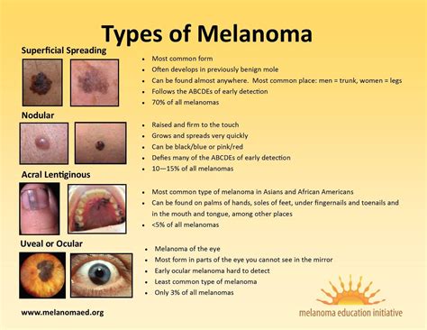 types  melanoma melanoma education initiative melanoma women legs